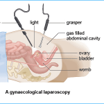 gynaecological laparoscopy