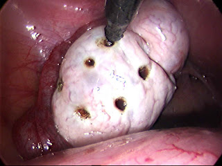 Ovarian_Drilling