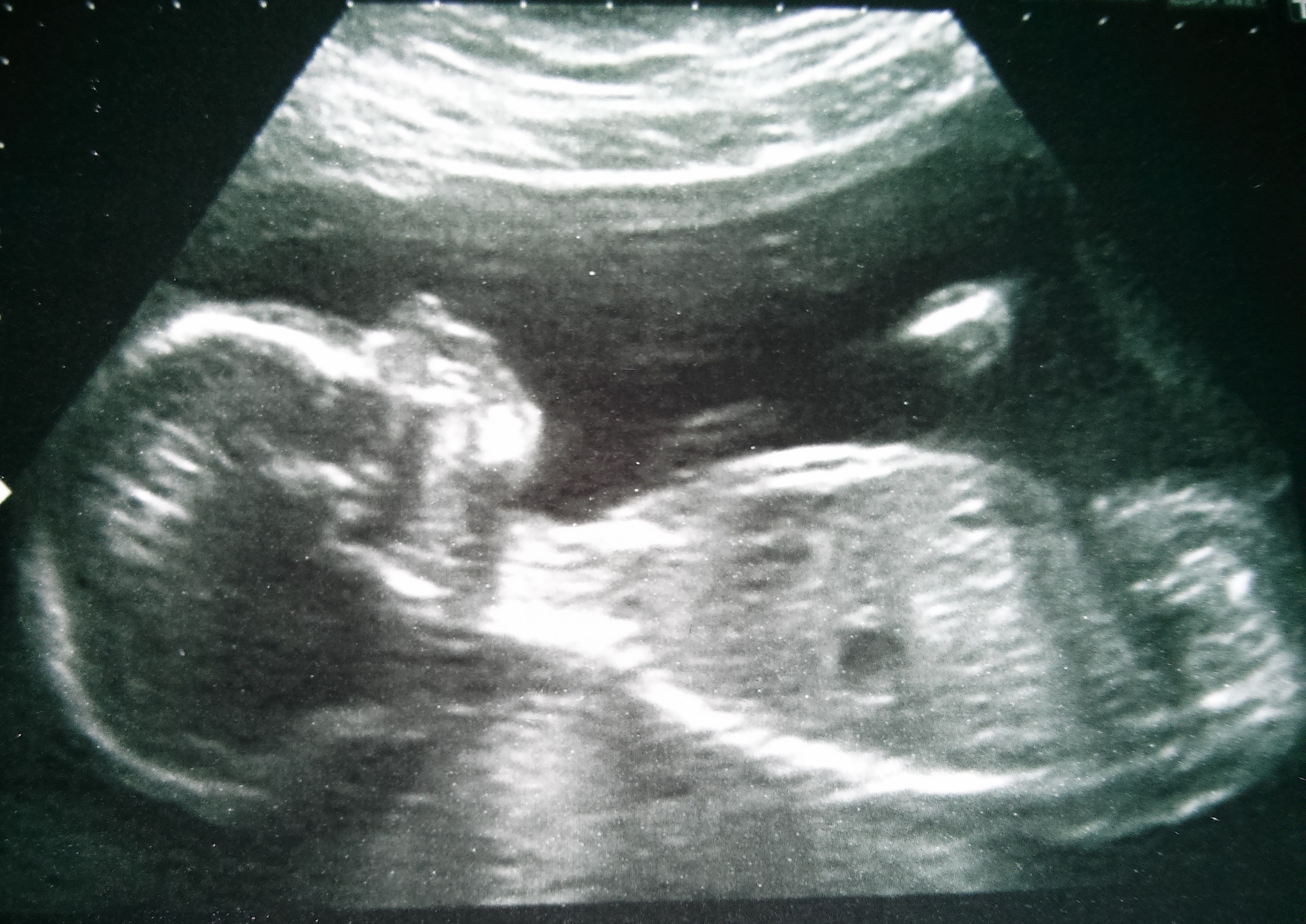 20-week scan